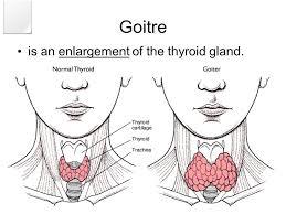 The relation between serum ferritin and goiter, urinary iodine and thyroid hormone concentration