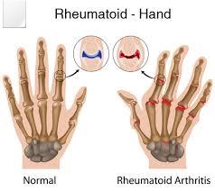 A pilot study of potassium supplementation in the treatment of hypokalemic patients with rheumatoid arthritis: a randomized, double-blinded, placebo-controlled trial.