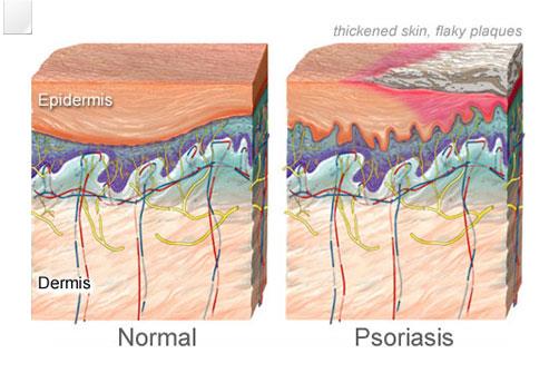 Psoriasis and vegetarian diets: a role for cortisol and potassium?