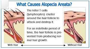 Alopecia and ocular alterations: a role for Minoxidil