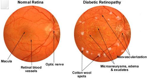 Possibility of enhanced risk of retinal neovascularization in repeated blood donors: blood donation and retinal alteration